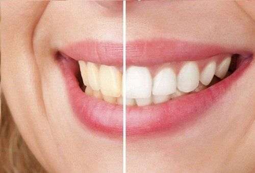 http://centredentairemassira.com/wp-content/uploads/2024/01/Blanchir-vos-dents-avec-un-ingredient-100-naturel.jpeg