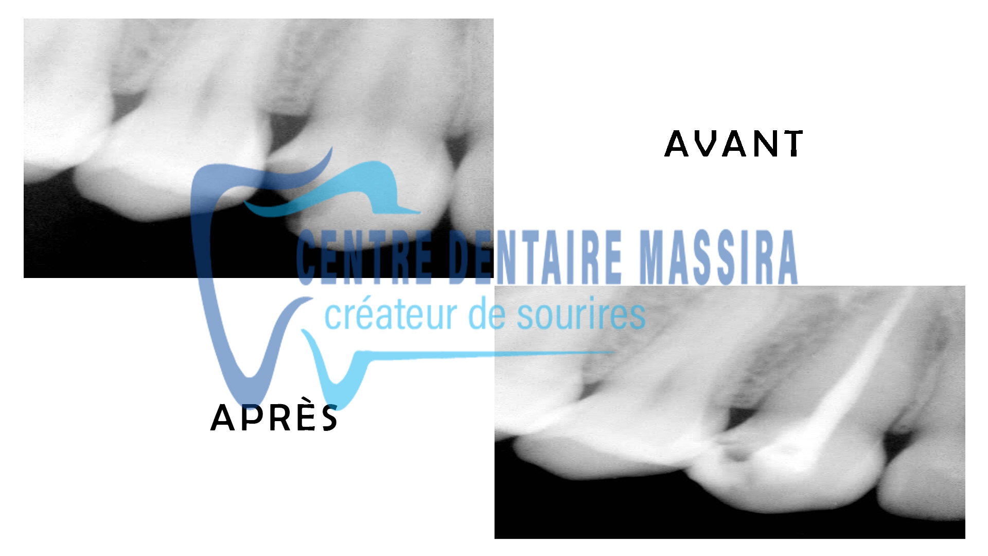 http://centredentairemassira.com/wp-content/uploads/2024/01/ENDODONTIE.jpg