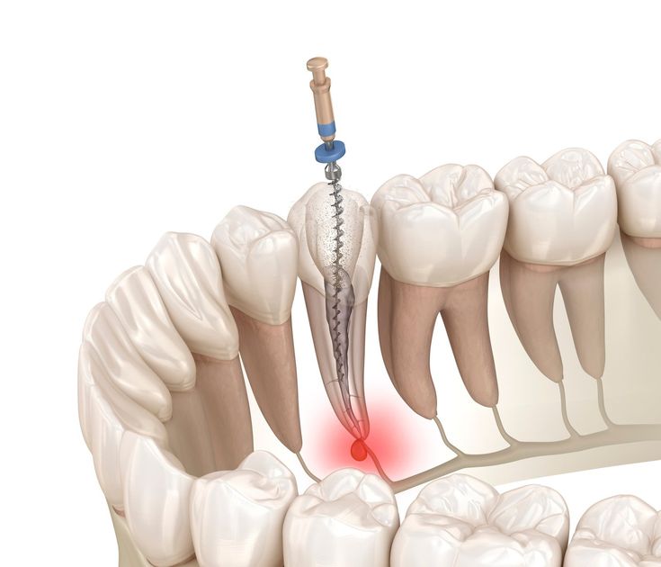 http://centredentairemassira.com/wp-content/uploads/2024/01/Endodontie.jpeg