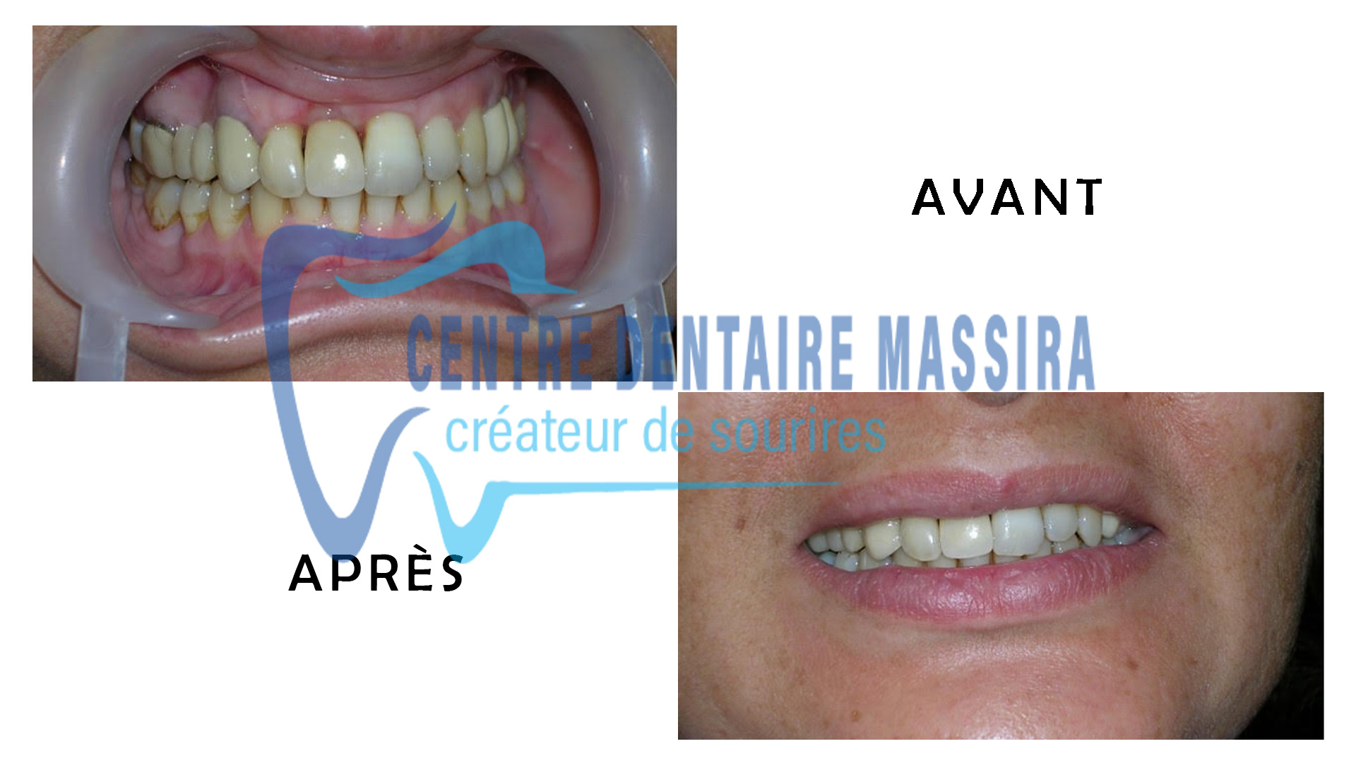 http://centredentairemassira.com/wp-content/uploads/2024/01/IMPLANT.jpg