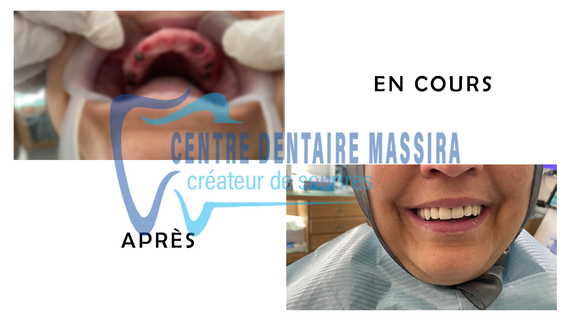 http://centredentairemassira.com/wp-content/uploads/2024/01/implantologie.jpg