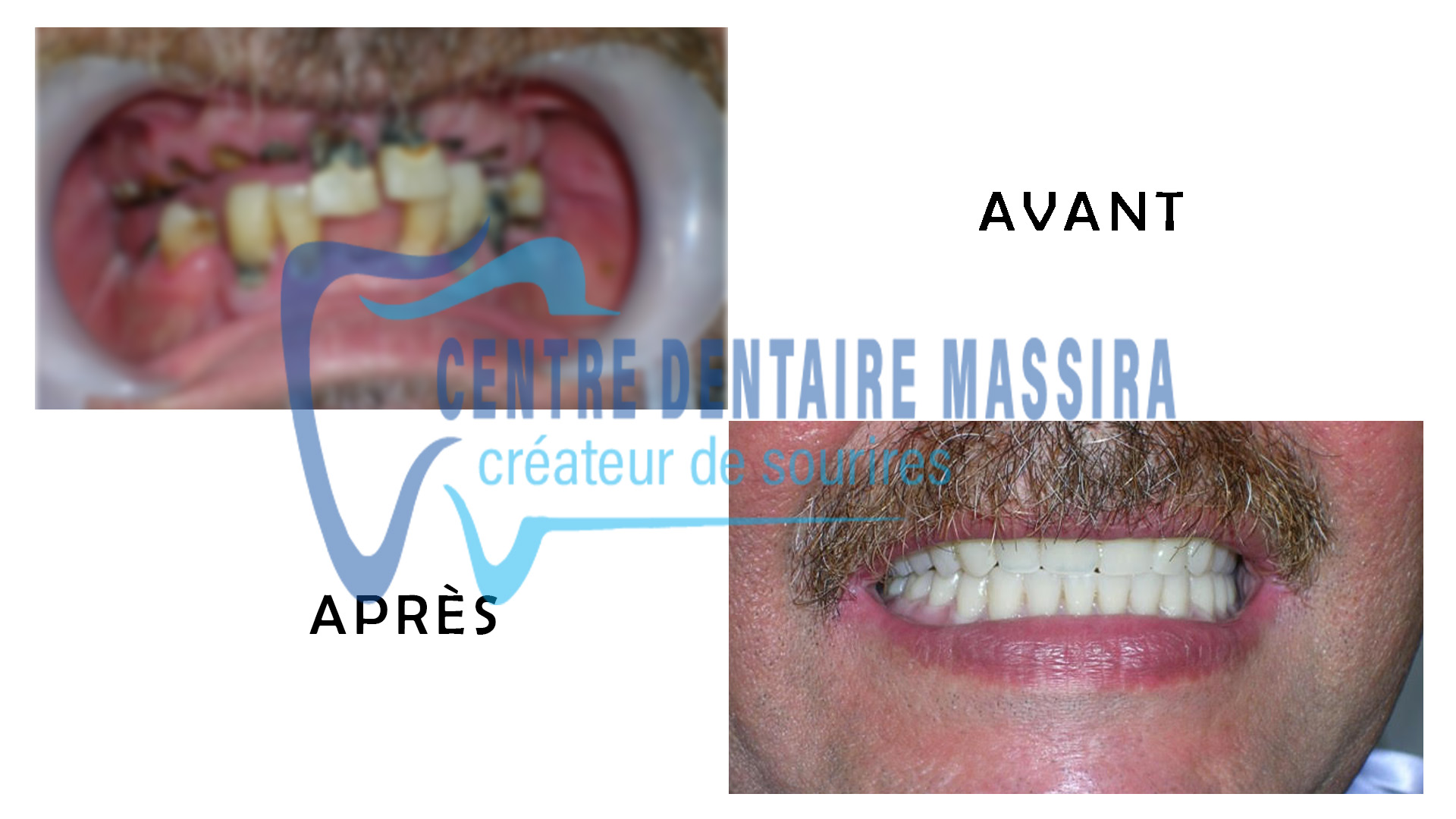 http://centredentairemassira.com/wp-content/uploads/2024/01/prothese-totale.jpg