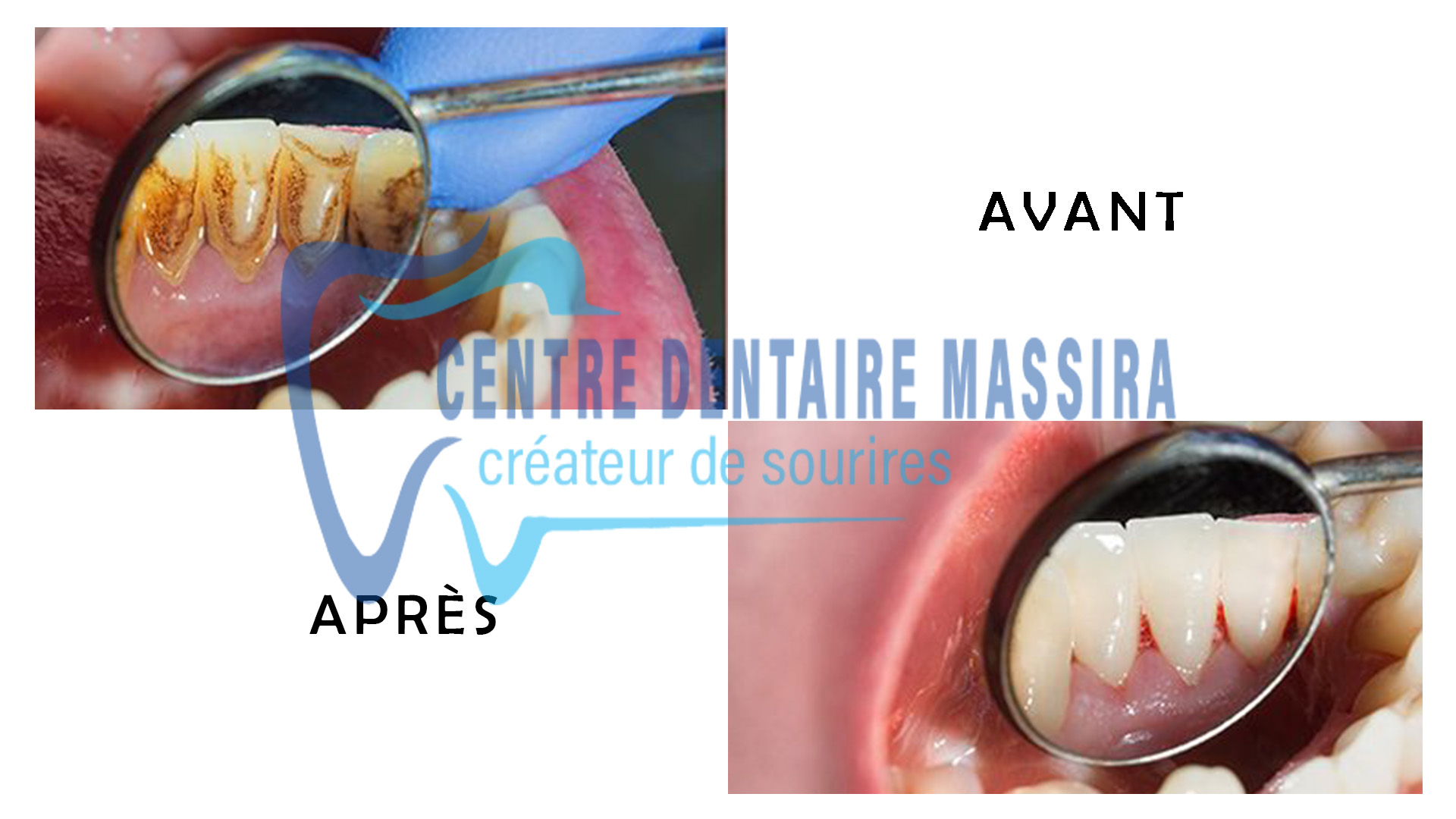 http://centredentairemassira.com/wp-content/uploads/2024/02/detartrage.jpg
